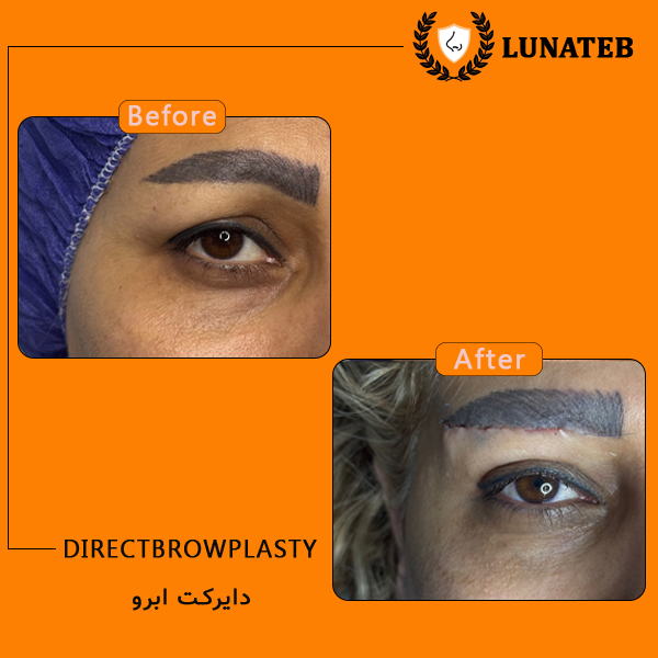 دایرکت ابرو-02 -Recovered